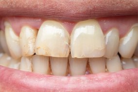 stained-teeth-before