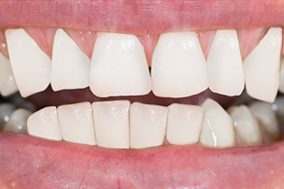stained-teeth-after