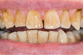 stained-teeth-before