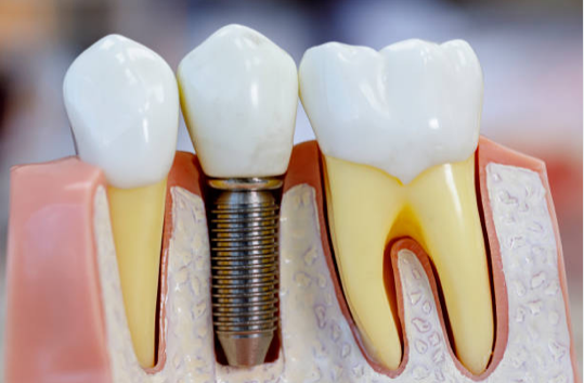 dental implants