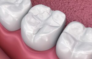 tooth-colored-fillings