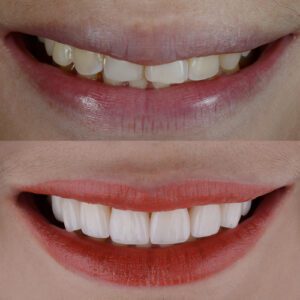 porcelain veneers