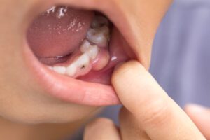 dental abscess